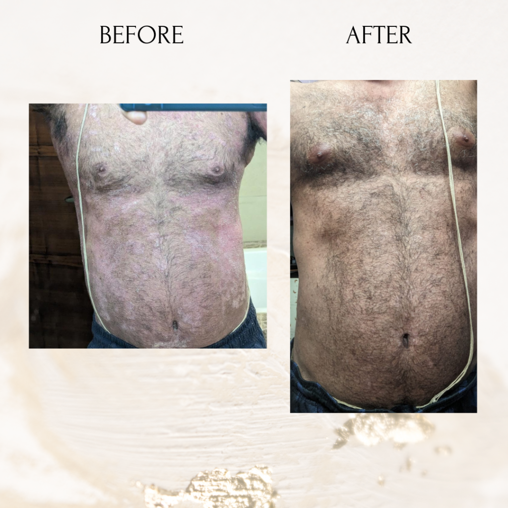 From 95% Psoriasis to 5%–10% on His Entire Body: A Success Story of Hope, Determination and Action