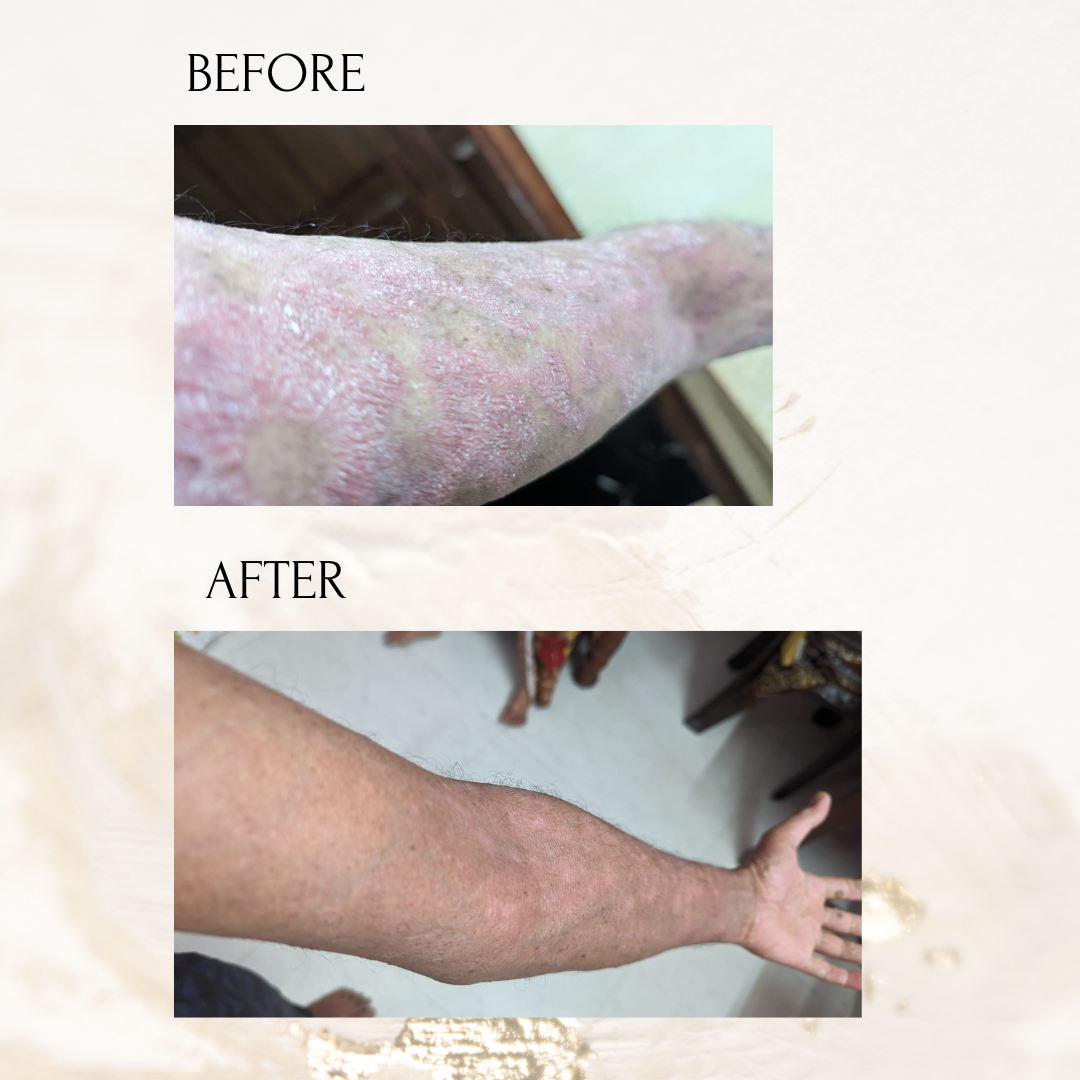 From 95% Psoriasis to 5%–10% on His Entire Body: A Success Story of Hope, Determination and Action