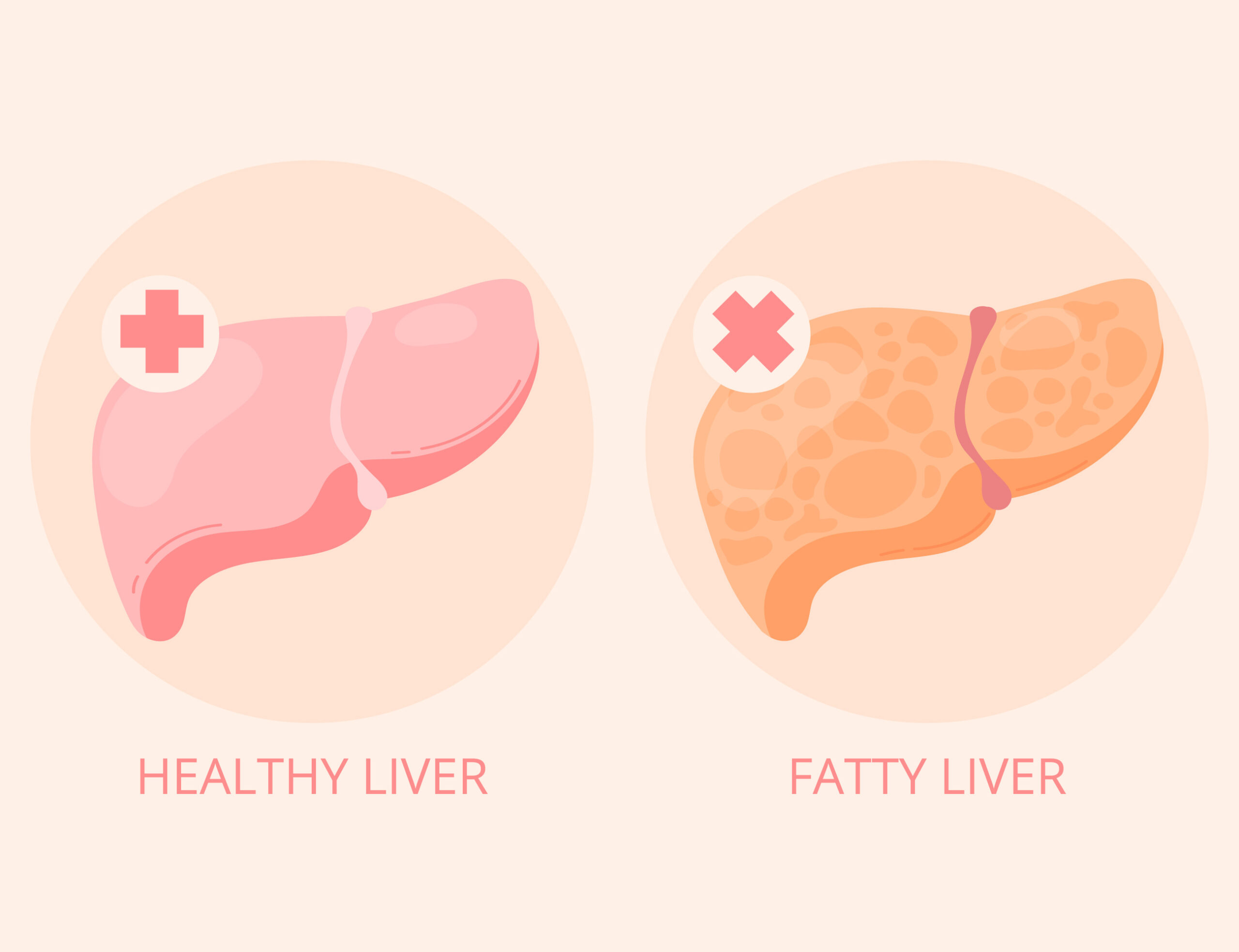 How To Reverse Fatty Liver? 13 Top Lifestyle Changes To Make Today