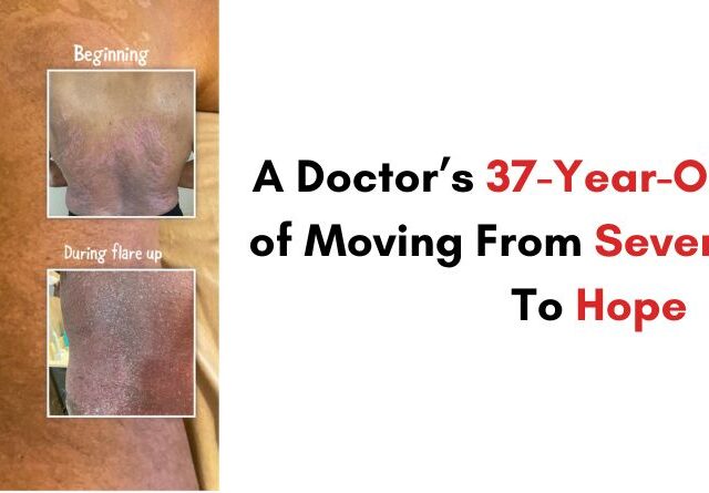 A Doctor’s 37-Year-Old Struggle of Moving From Severe Psoriasis To Hope