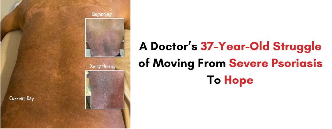 A Doctor’s 37-Year-Old Struggle of Moving From Severe Psoriasis To Hope
