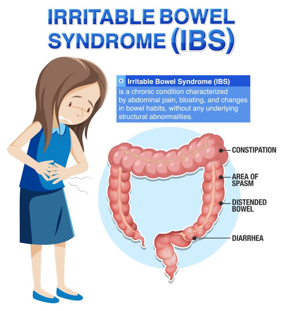 Irritable Bowel Syndrome (IBS) Infographic