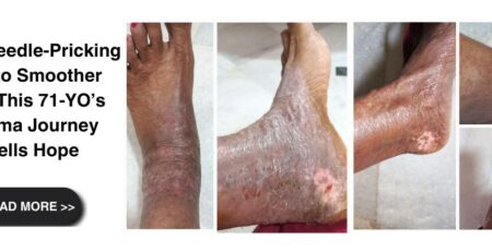 From Needle-Pricking Pain to Smoother Skin: This 71-YO’s eczema Journey Spells Hope