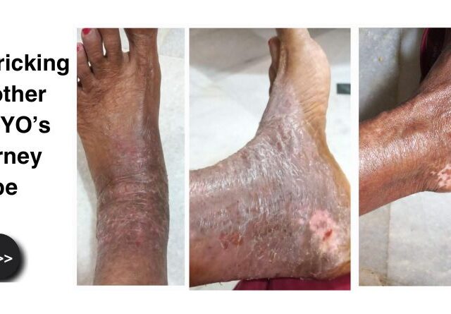 From Needle-Pricking Pain to Smoother Skin: This 71-YO’s eczema Journey Spells Hope