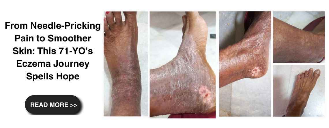 From Needle-Pricking Pain to Smoother Skin: This 71-YO’s eczema Journey Spells Hope