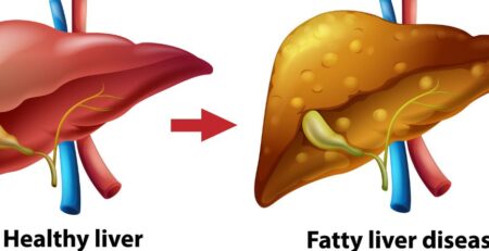 The Truth About Non-Alcoholic Fatty Liver Disease: What You’re Not Being Told