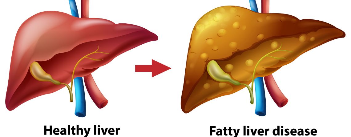 The Truth About Non-Alcoholic Fatty Liver Disease: What You’re Not Being Told