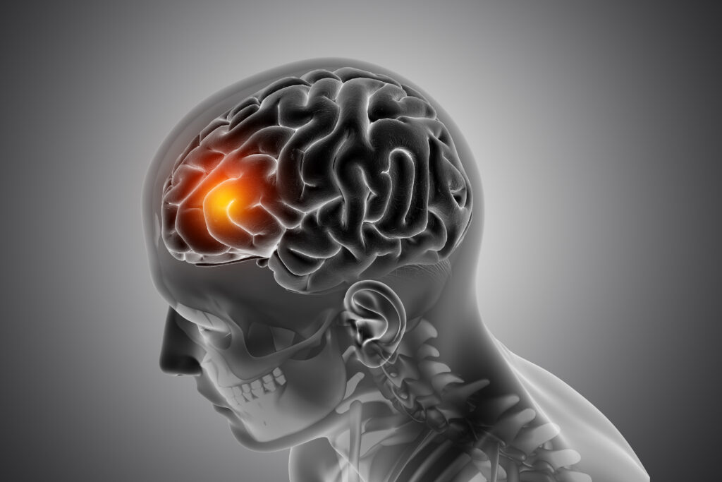 Symptoms of Brain Aneurysms