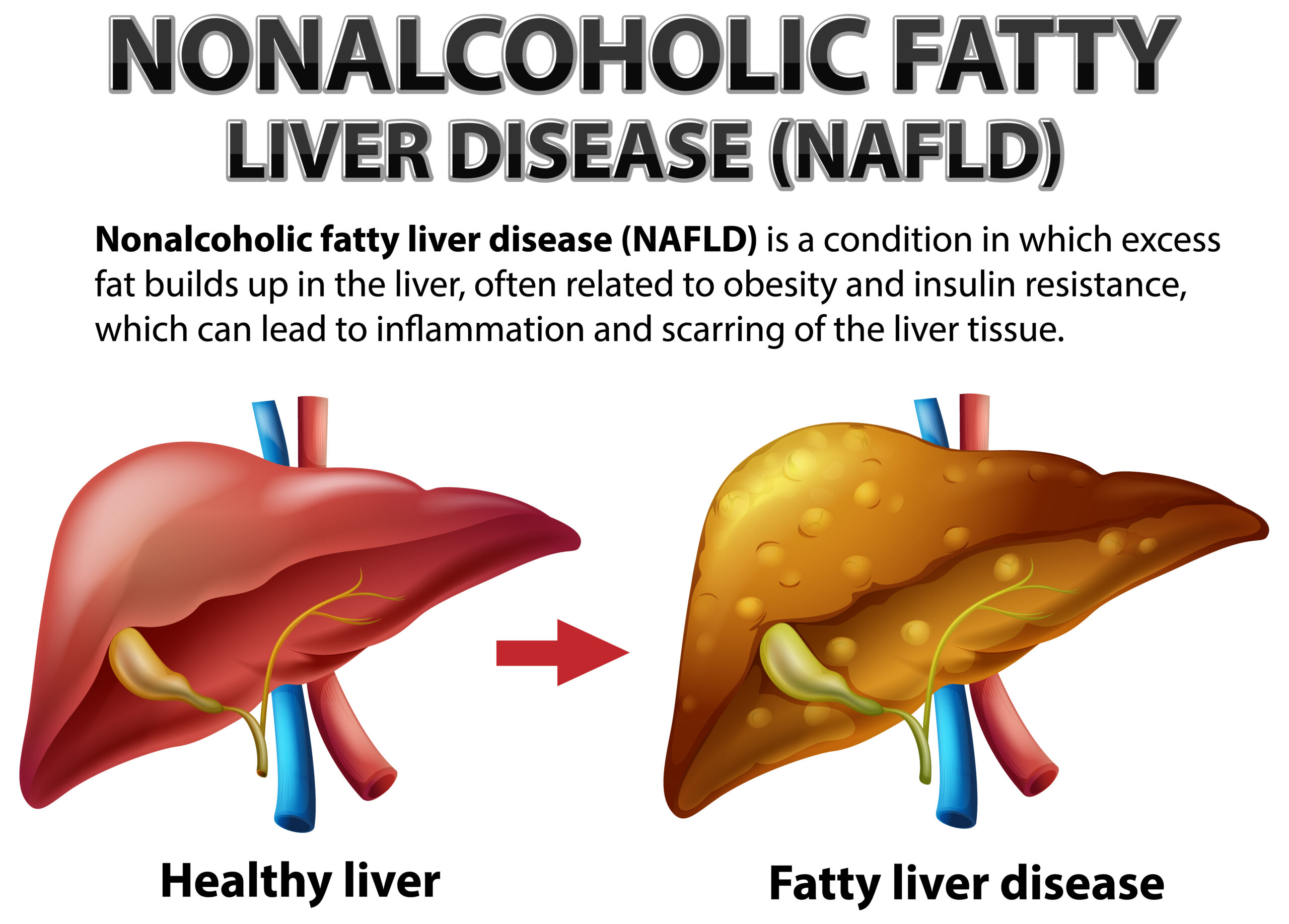 non-alcoholic-fatty-liver