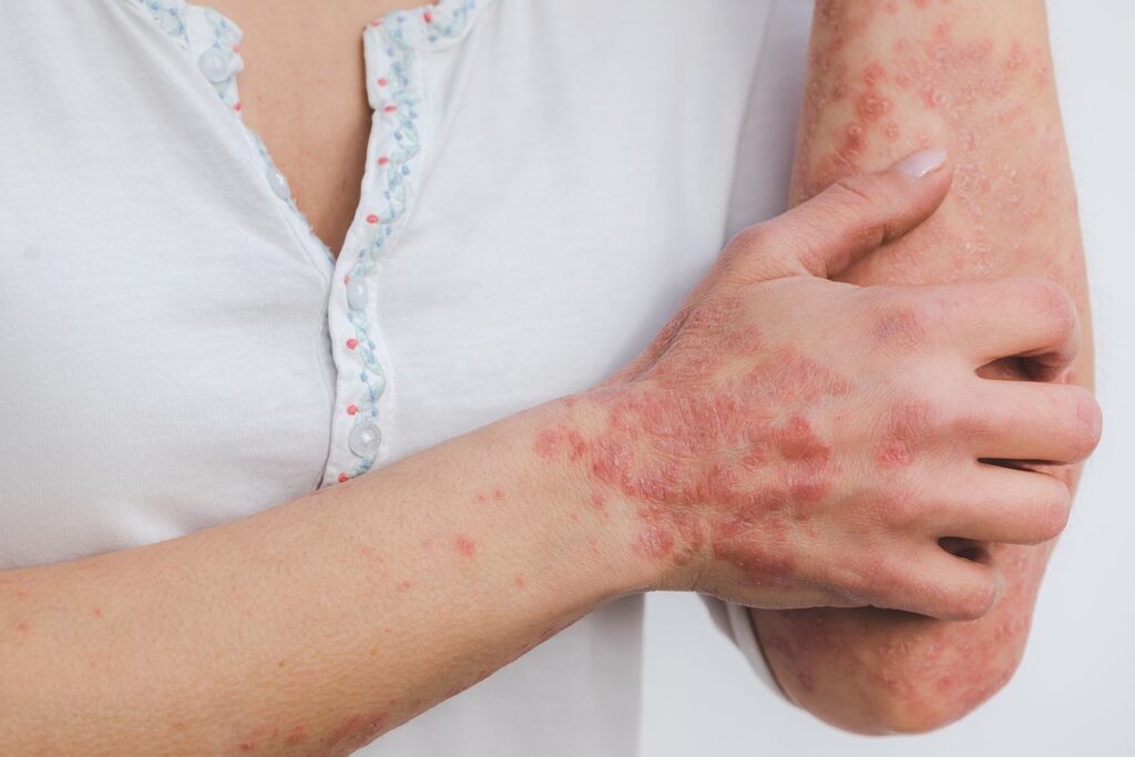 Psoriasis: definition, symptoms, triggers