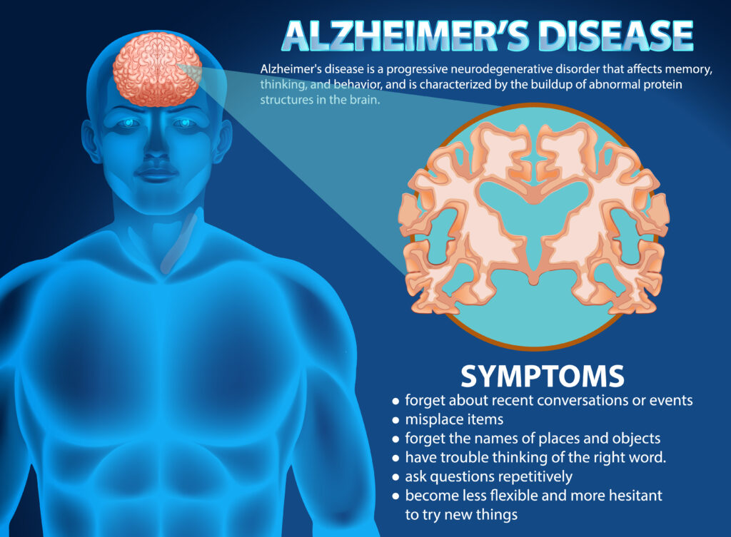 Informative poster of Alzheimer's disease illustration